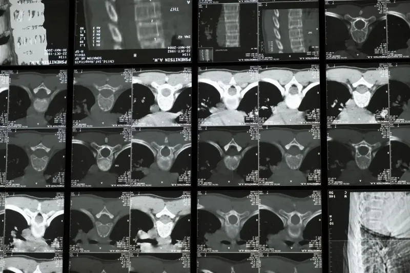 Neuroimplants Are Expected To Enter Clinical Trials For Memory Enhancement. Neuroimplants Are Expected To Enter Clinical Trials For Memory Enhancement.