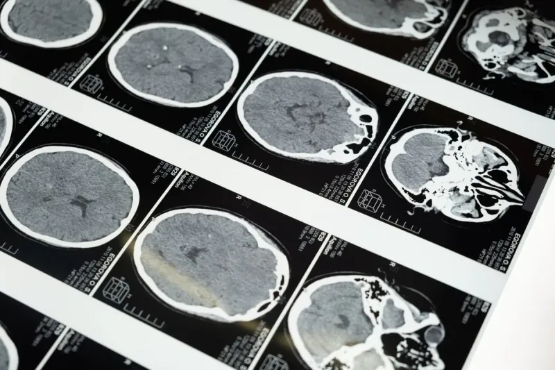 Neuromodulation Devices That Improve Sleep Quality Are Expected To Become Commercial.